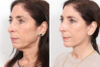 Facelift case #3040 slider thumbnail