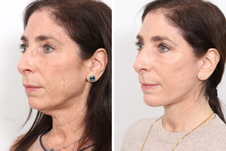 Facelift case #3040