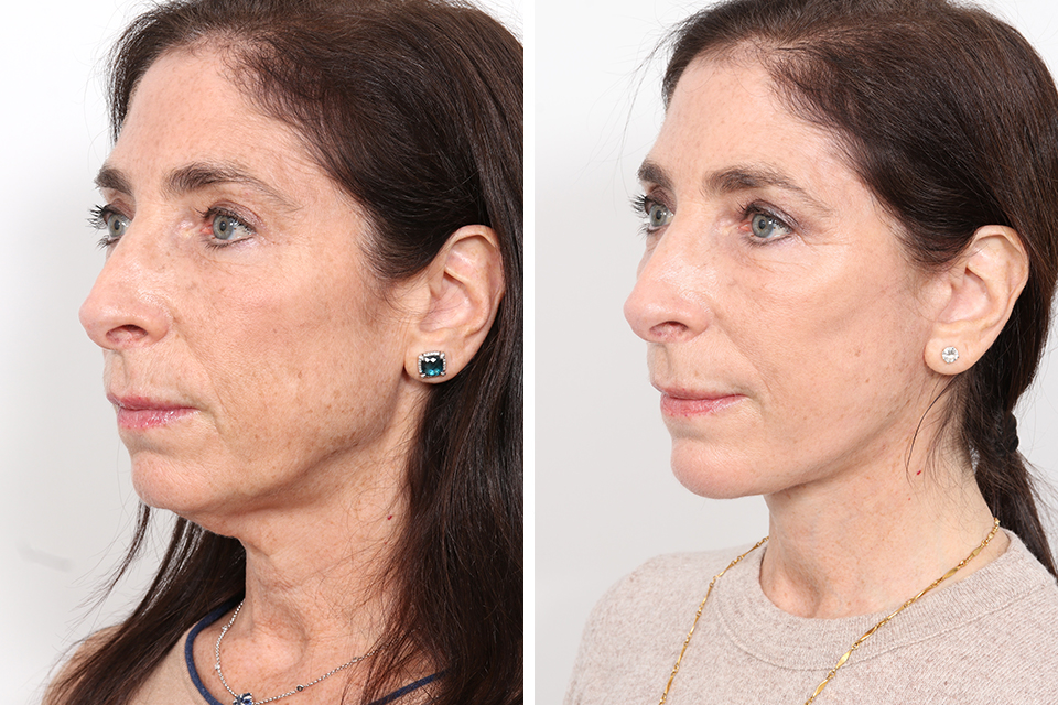 Facelift case #3040