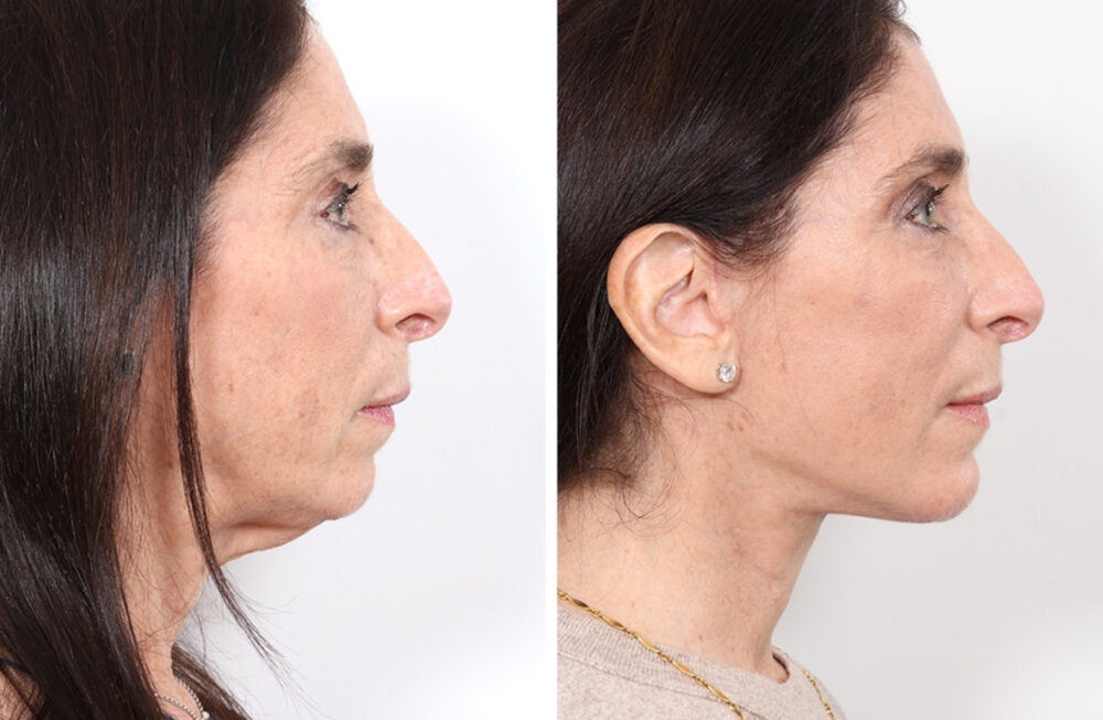 Facelift case #3040