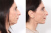 Facelift case #3040 slider thumbnail