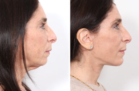 Facelift case #3040