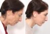 Facelift case #3040 slider thumbnail
