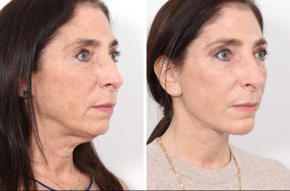 Facelift case #3040