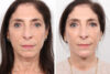 Facelift case #3040 slider thumbnail