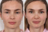 Eyelid Surgery case #3046 slider thumbnail