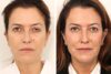 Eyelid Surgery case #3059 slider thumbnail