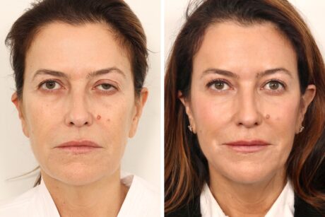 Eyelid Surgery case #3059