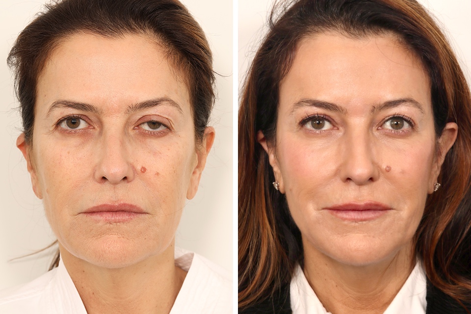 Eyelid Surgery case #3059