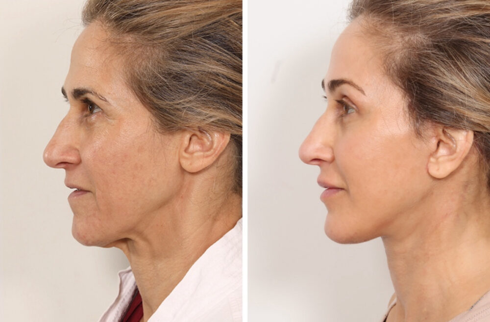 Facelift case #3048