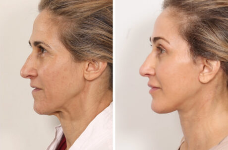 Facelift case #3048