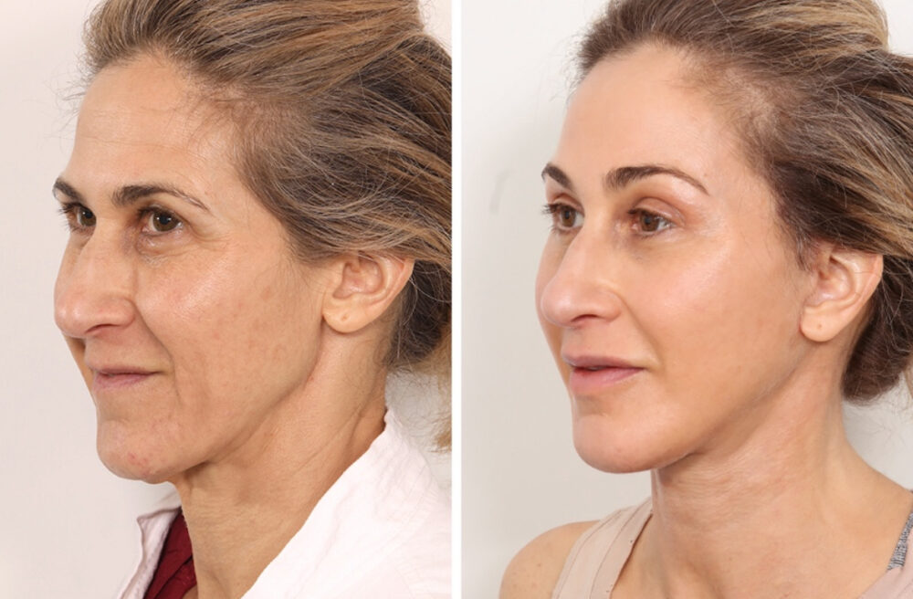 Facelift case #3048