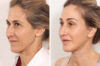 Facelift case #3048 slider thumbnail