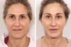 Facelift case #3048 slider thumbnail