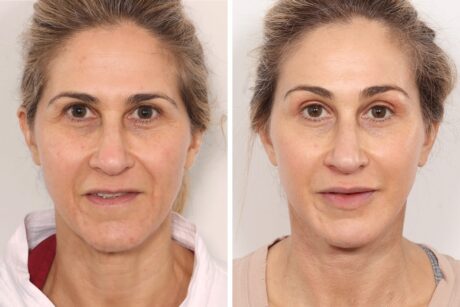 Facelift case #3048