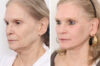 Eyelid Surgery case #3167 slider thumbnail
