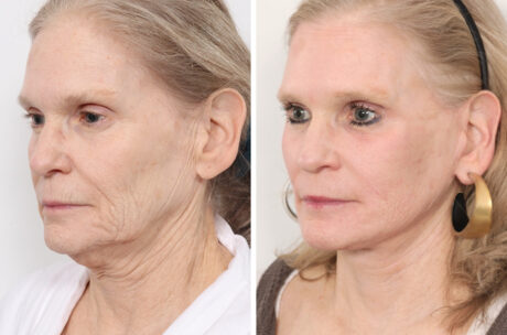 Eyelid Surgery case #3167
