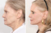 Eyelid Surgery case #3167 slider thumbnail