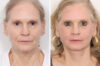 Eyelid Surgery case #3167 slider thumbnail