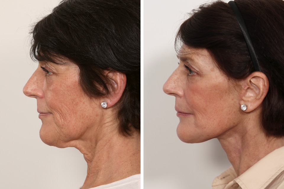Facelift case #3052
