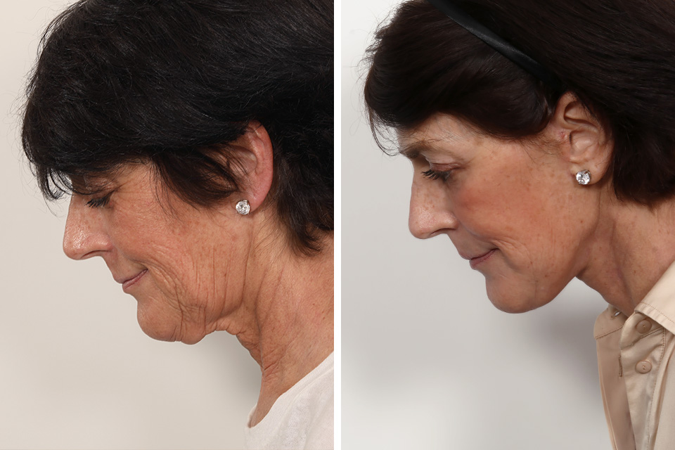 Facelift case #3052