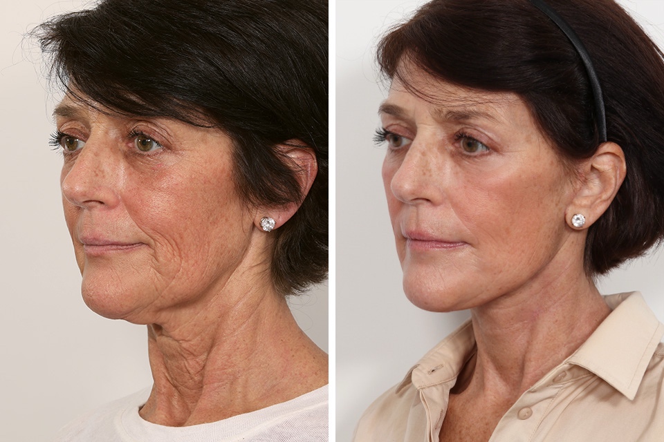 Facelift case #3052