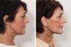Facelift case #3052 slider thumbnail