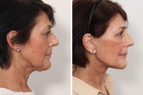 Facelift case #3052