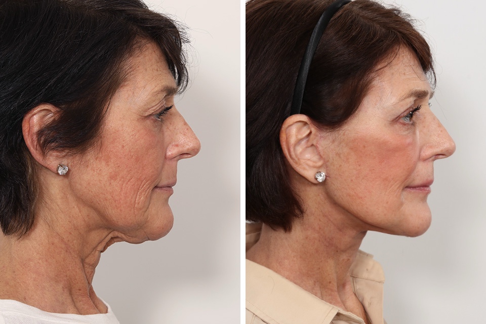 Facelift case #3052