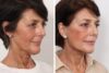 Facelift case #3052 slider thumbnail