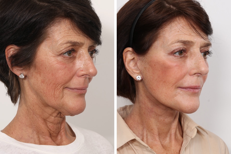 Facelift case #3052
