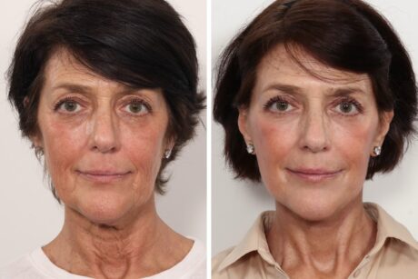 Facelift case #3052