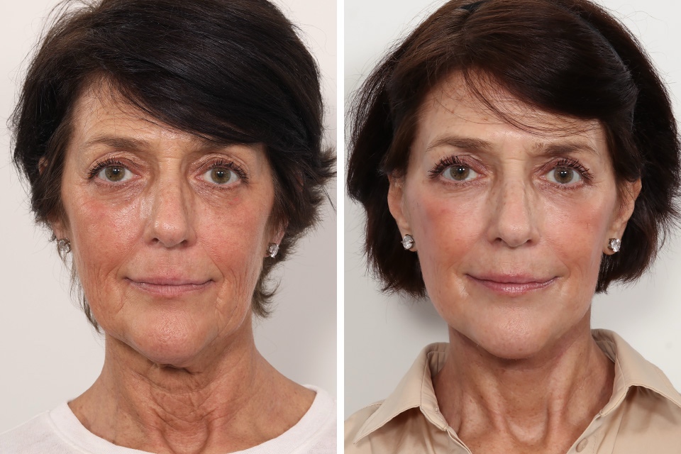 Facelift case #3052