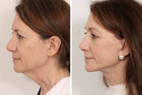 Facelift case #3061