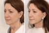 Facelift case #3061 slider thumbnail