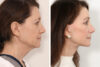 Facelift case #3061 slider thumbnail