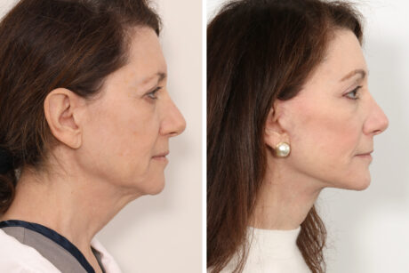 Facelift case #3061