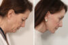Facelift case #3061 slider thumbnail