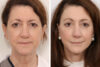 Facelift case #3061 slider thumbnail