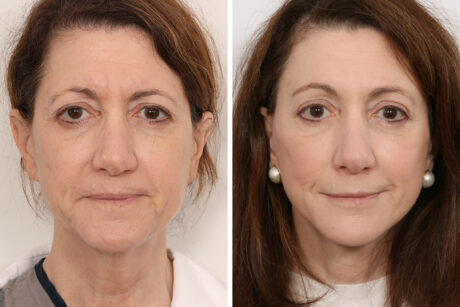 Facelift case #3061