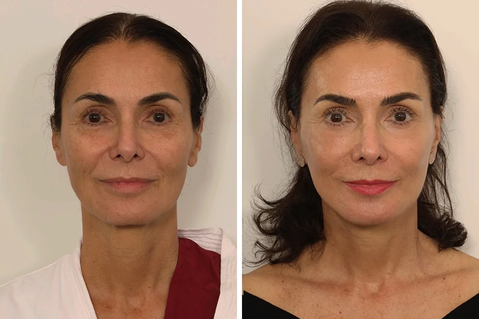Facelift case #3007