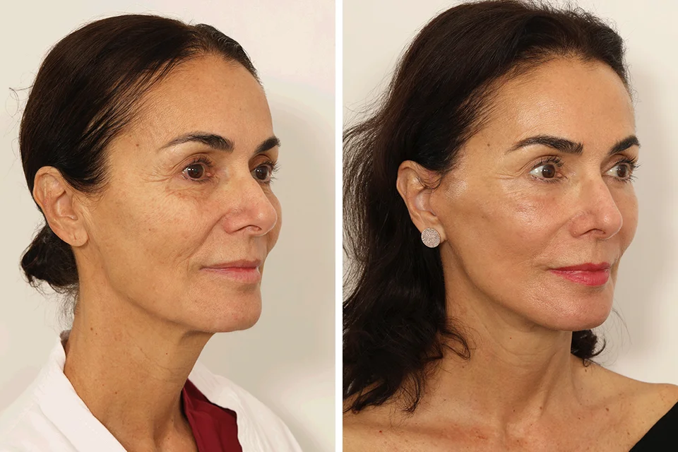 Facelift case #3007