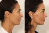 Facelift case #3007 slider thumbnail