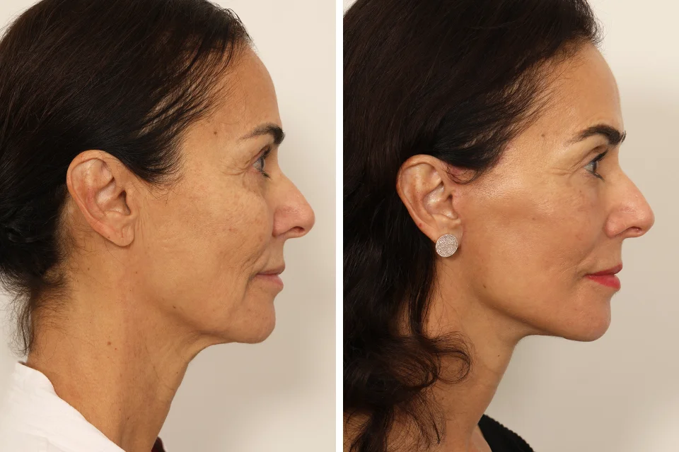 Facelift case #3007