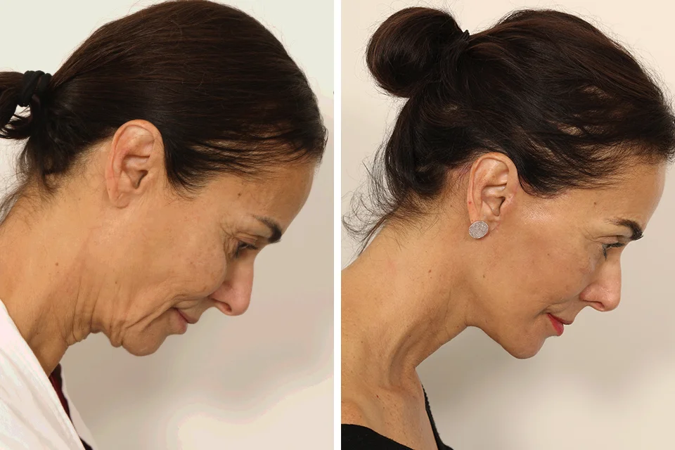 Facelift case #3007