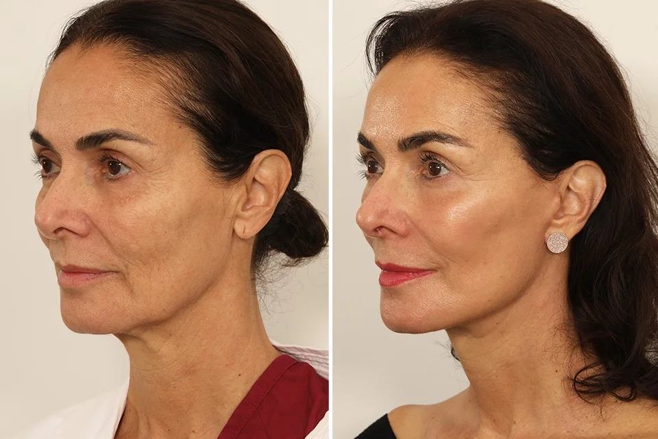 Facelift case #3007