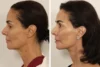 Facelift case #3007 slider thumbnail