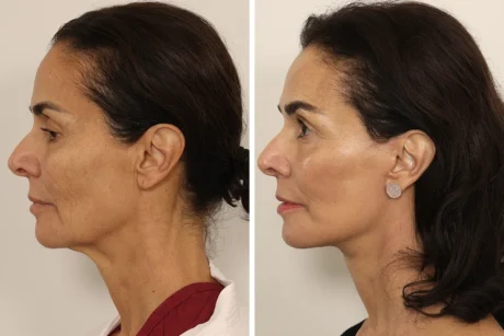 Facelift case #3007
