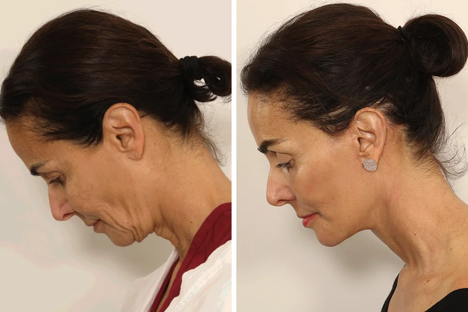 Facelift case #3007