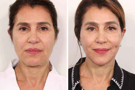 Browlift case #3267
